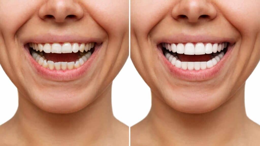 Before and after teeth whitening results. Mansfield