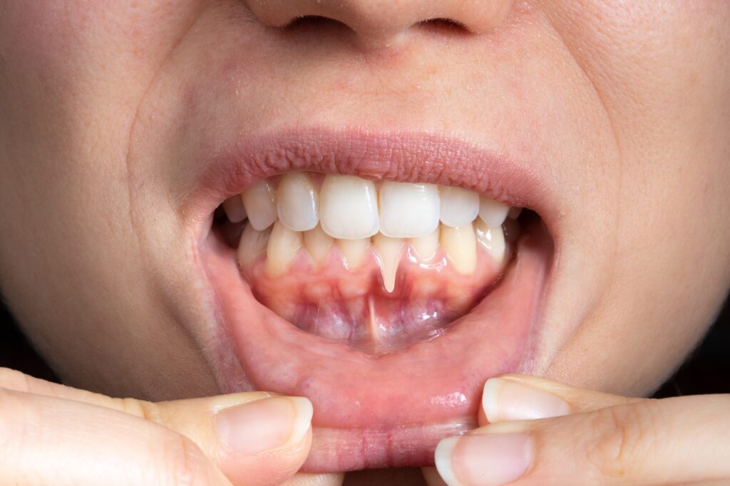 Preparing for teeth whitening with receding gums Mansfield